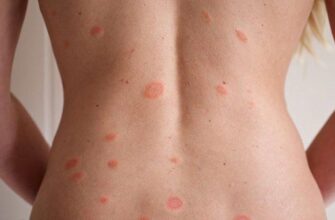 Що таке лишай: види, симптоми та методи лікування захворювання