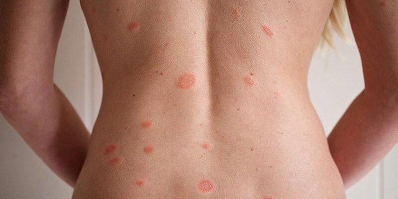 Що таке лишай: види, симптоми та методи лікування захворювання