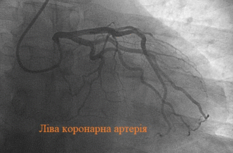 Коронарографія: Що Це Таке та Які Переваги Для Вашого Здоров’я?