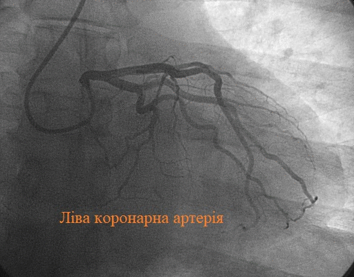 Коронарографія: Що Це Таке та Які Переваги Для Вашого Здоров’я?