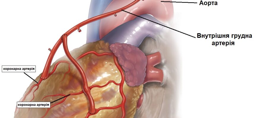 Шунтування серця: що це таке та як проходить операція?