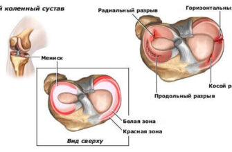 Розуміння меніска коліна: функції, травми та лікування для вашого здоров’я