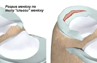 Що таке меніск: важливість, функції та лікування пошкоджень