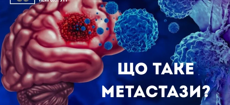 Що таке метастази: причини, симптоми та методи лікування раку