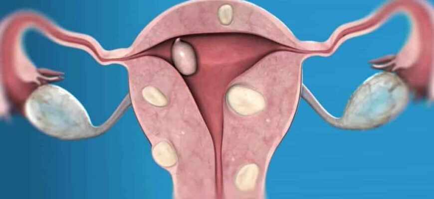 Що таке міома: причини, симптоми та методи лікування захворювання