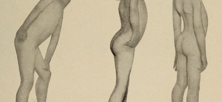 Що таке міопатія: симптоми, діагностика та сучасні методи лікування