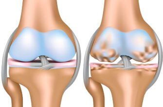 Остеоартроз: причини, симптоми та методи лікування захворювання