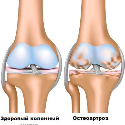 Остеоартроз: причини, симптоми та методи лікування захворювання