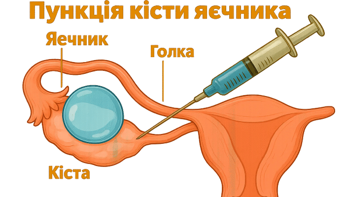 Пункція: визначення, призначення та особливості процедури