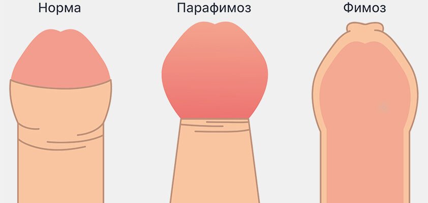 Фімоз: Причини, симптоми та ефективні методи лікування стану