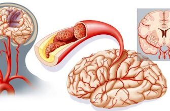 Заголовок: Інсульт: Причини, Симптоми та Ефективні Методи Профілактики