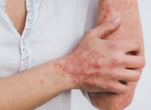 Що таке псоріаз: ознаки, причини та ефективні методи лікування