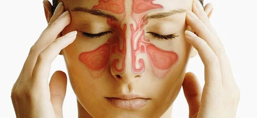 Що таке алергічний риніт: симптоми, причини та лікування хвороби