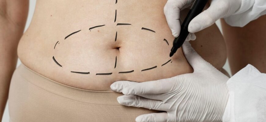 “Абдоминопластика: все, что нужно знать о процедуре и ее результатах”
