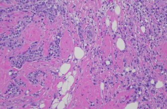 Що таке катаракта: основні симптоми, причини та методи лікування