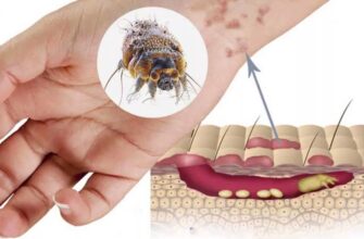 Чесотка: причины, симптомы и эффективные методы лечения болезни