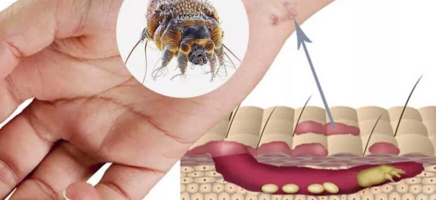 Чесотка: причины, симптомы и эффективные методы лечения болезни