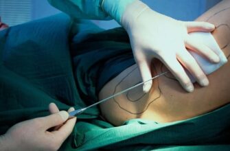 Липосакция: что это такое и как проходит процедура удаления жира?