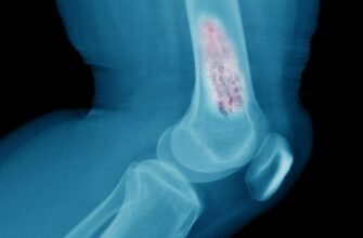 Розуміння саркоми: причини, симптоми та ефективні методи лікування