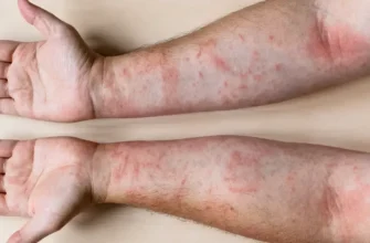 Ось оптимізований заголовок для вашої статті:

Що таке атопічний дерматит: симптоми, причини та методи лікування