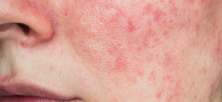 Що таке розацеа: причини, симптоми та ефективні методи лікування