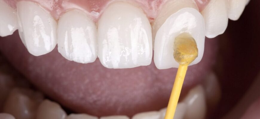 Що таке вініри: переваги, встановлення та догляд за зубними накладками