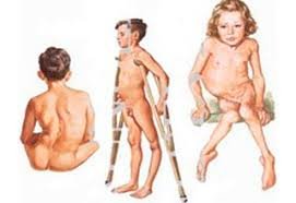 “Поліомієліт: що це таке і як захиститися від небезпечного вірусу”