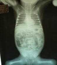 Кишкова непрохідність: визначення, причини та методи лікування