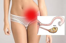 Кіста яєчника: що це таке, основні симптоми та методи лікування