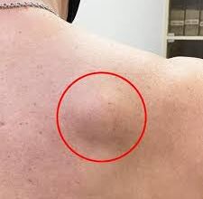 Що таке жировик: особливості, причини та методи лікування дефекту