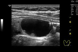Що таке кіста Бейкера: причини, симптоми та методи лікування