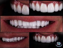 Коронка на зуб: Види, Вартість та Процес Встановлення в Україні