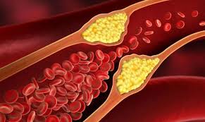 Коефіцієнт атерогенності: що це, як обчислити і чому він важливий