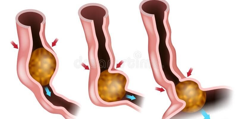 Що таке перистальтика: основи шлунково-кишкових рухів для здоров’я