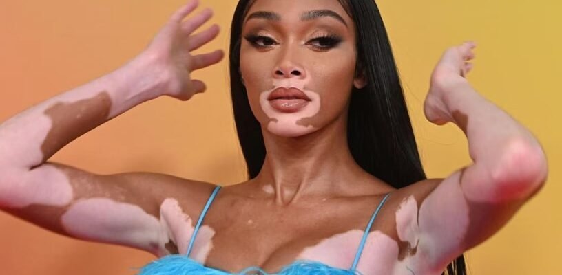 Что такое витилиго: причины, симптомы и методы лечения болезни Что такое витилиго: причины, симптомы и методы лечения болезни