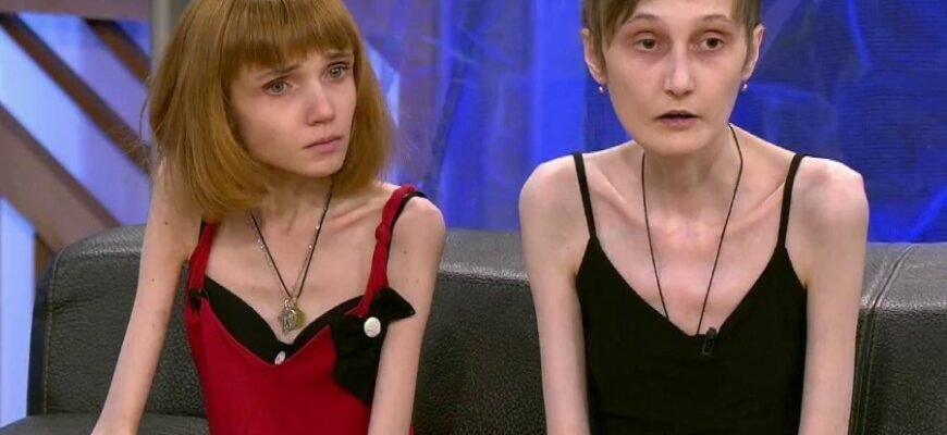 Анорексия: причины, симптомы и способы лечения расстройства