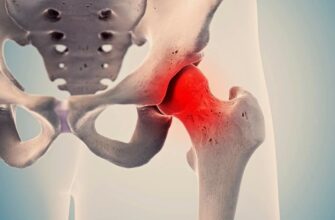 Коксартроз: Причины, симптомы и методы лечения заболевания тазобедренного сустава