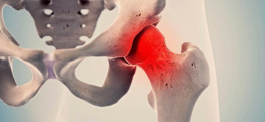 Коксартроз: Причины, симптомы и методы лечения заболевания тазобедренного сустава