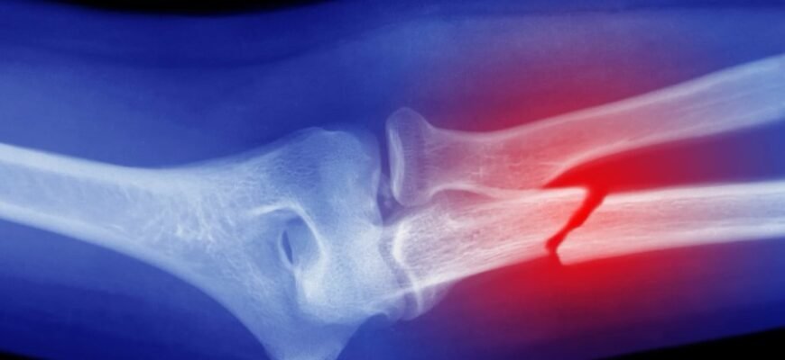 Перелом: определение, причины и способы лечения травмы кости