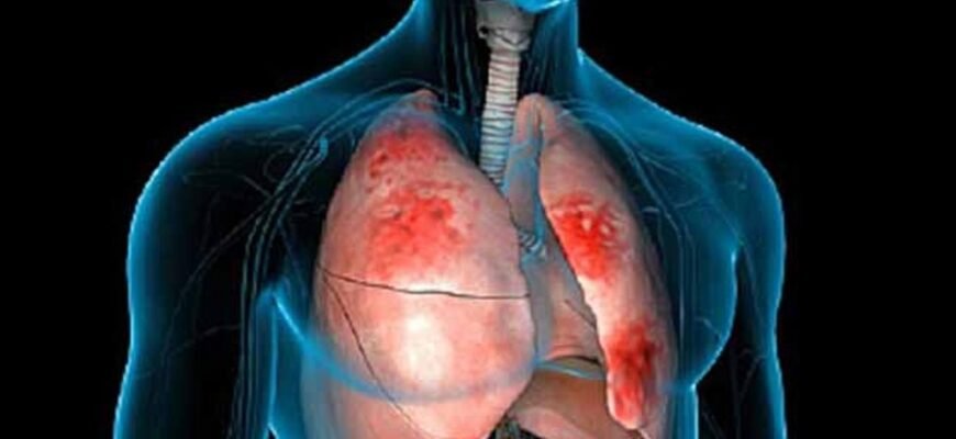 Что такое пневмония: причины, симптомы и методы лечения заболевания