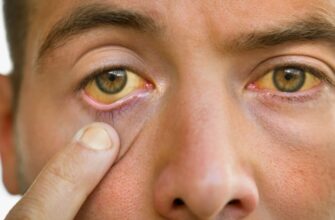 Что такое желтуха: причины, симптомы и методы лечения заболевания