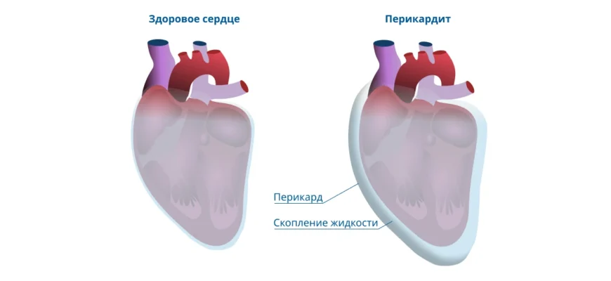 Що таке перикард: функції, будова та важливість для здоров’я серця